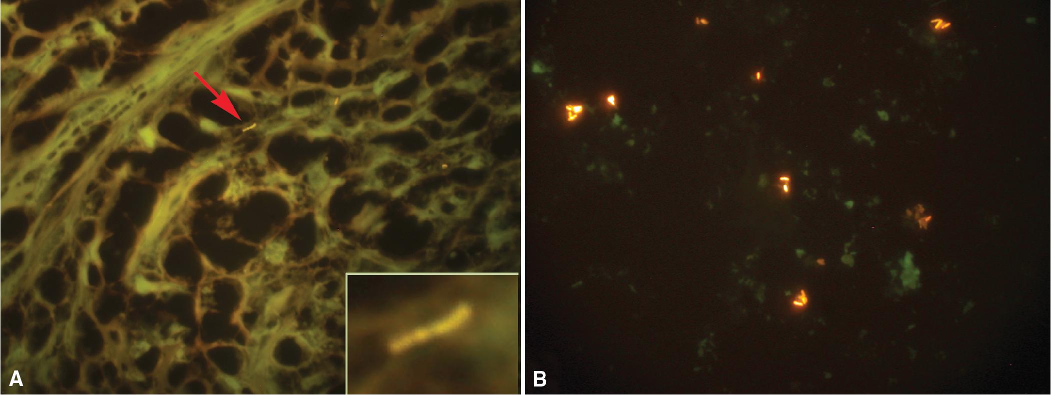 Figure 7.8, Fluorescent bacillary organisms: Mycobacterium tuberculosis . (A) Tissue section with two bacilli (auramine-rhodamine stain). Note beaded character in closeup view (inset) . (B) Low-power view.