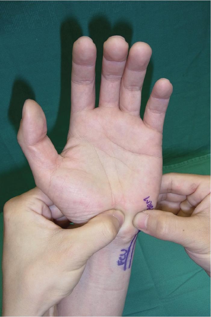 FIGURE 23.2, An LT shear test allows the examiner to stress the LT interval by manually manipulating the lunate and triquetrum to test for pain, crepitus, or laxity compared with the contralateral side. LT, Lunotriquetral.