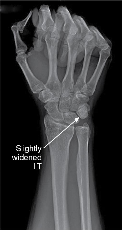 FIGURE 23.3, X-ray demonstrating slight LT interval widening (arrow points to widened LT interval). LT, Lunotriquetral.