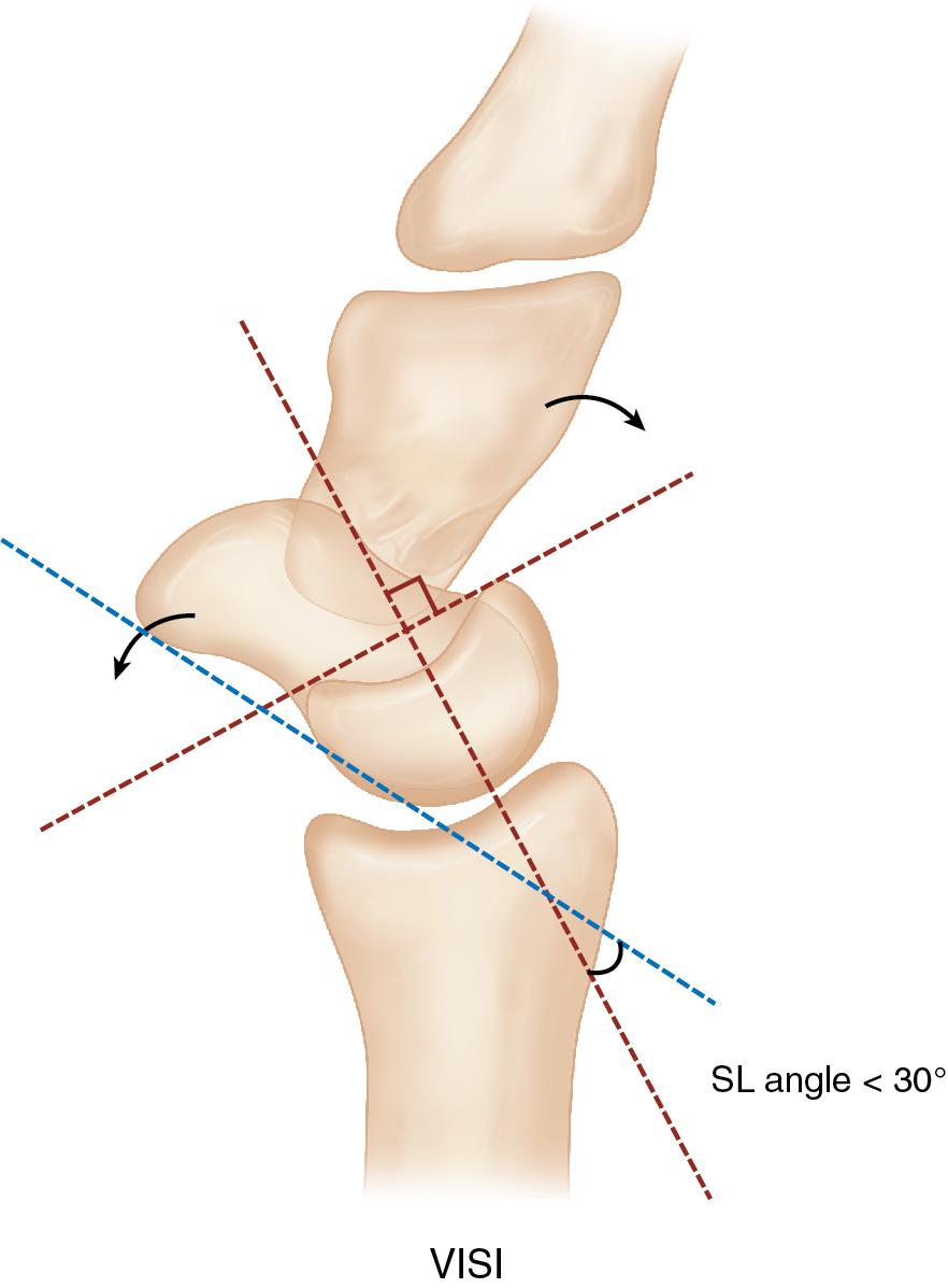 FIGURE 23.4, Illustration of the carpal relationship that develops in a volar intercalated segment instability (VISI) deformity, with the scapholunate (SL) angle more acute than normal.