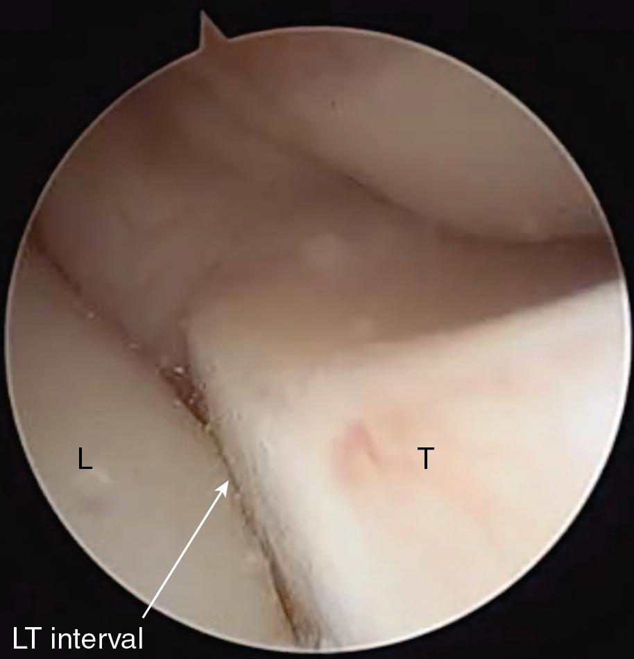 FIGURE 23.5, Arthroscopic image from a midcarpal view showing an LT step-off associated with Grade III instability. Arrow points to the incongruous LT interval. L , Lunate; LT, lunotriquetral; T , triquetrum.