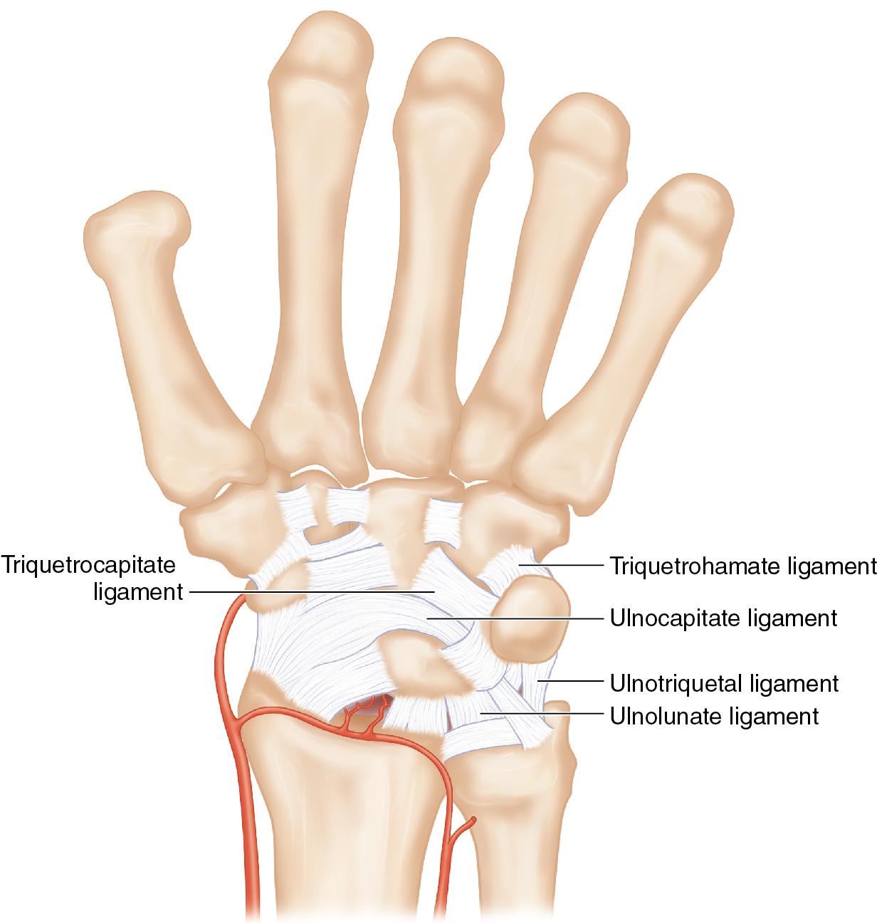 FIGURE 23.6, Illustration of the main volar secondary stabilizers of the LT interval. LT, Lunotriquetral.