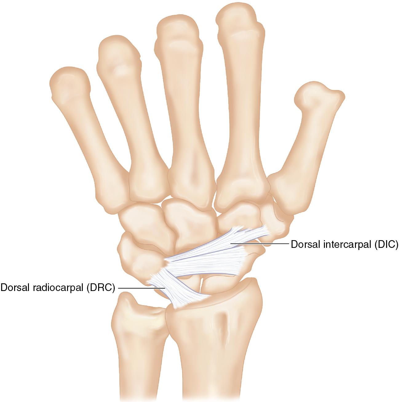 FIGURE 23.7, Illustration of the main dorsal secondary stabilizers of the LT interval. LT, Lunotriquetral.