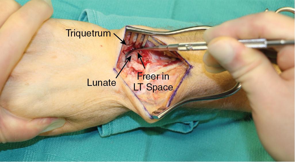 FIGURE 23.9, Dorsal exposure of the LT region of the wrist. The freer is easily able to pass between the lunate and triquetrum, indicating a torn LT ligament. LT, Lunotriquetral.