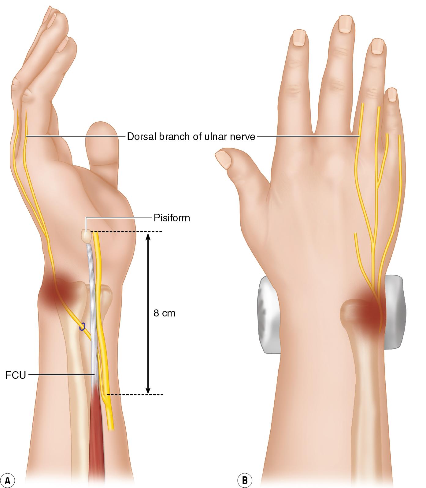 FIGURE 23.10, Illustration of the course of the dorsal sensory branch of the ulnar nerve. FCU , Flexor carpi ulnaris