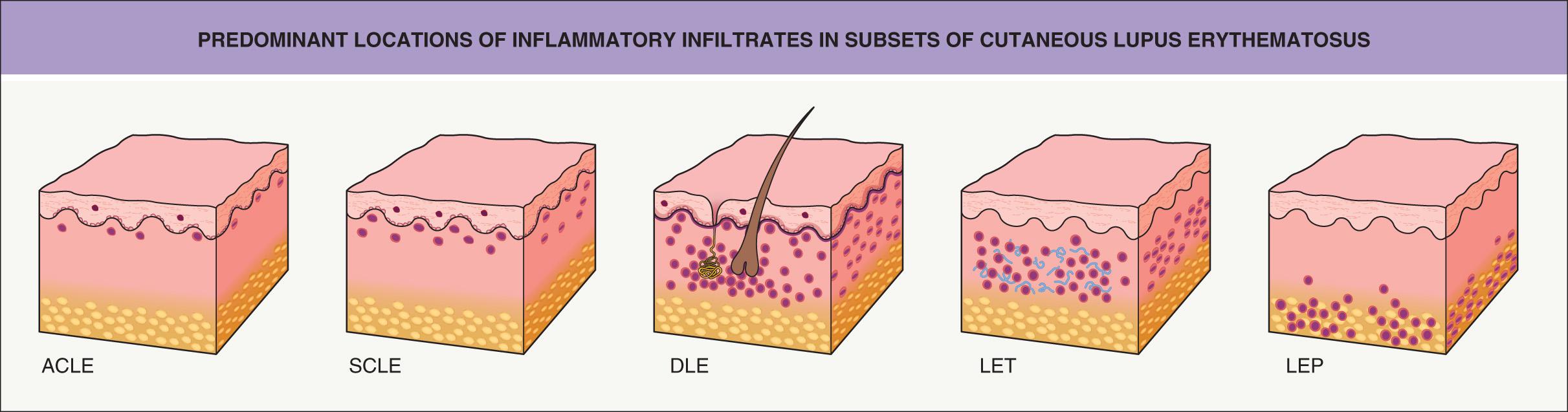 Fig. 41.3, Predominant locations of inflammatory infiltrates in subsets of cutaneous lupus erythematosus.