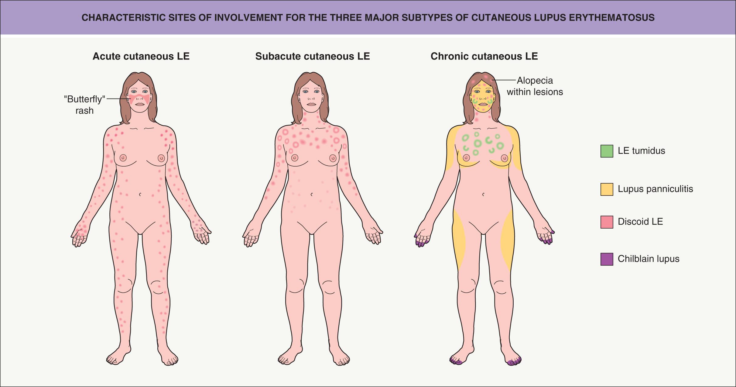 Fig. 41.4, Characteristic sites of involvement for the three major forms of cutaneous lupus erythematosus (LE).
