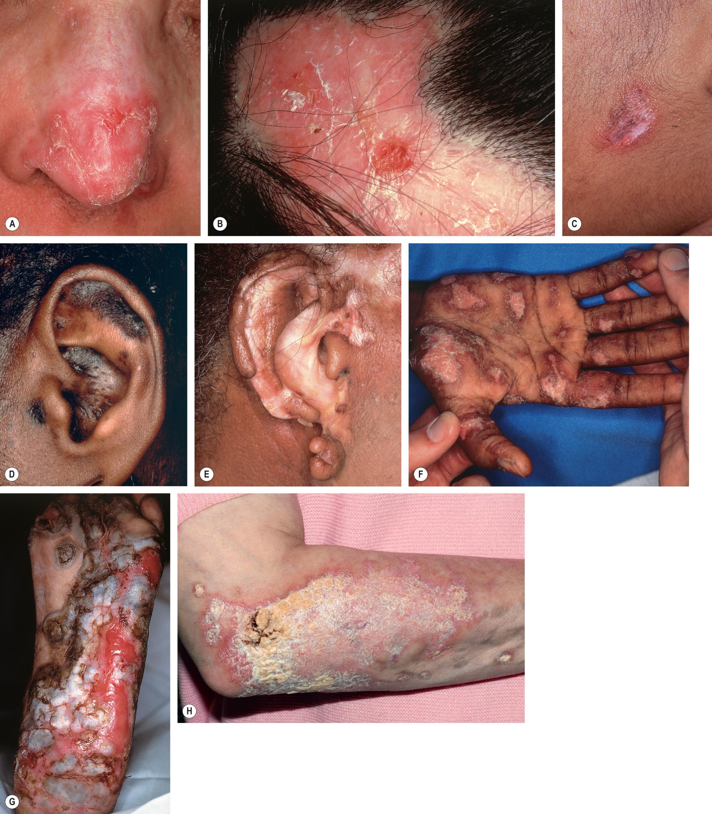 Fig. 41.5, Various presentations of discoid lesions of lupus erythematosus.