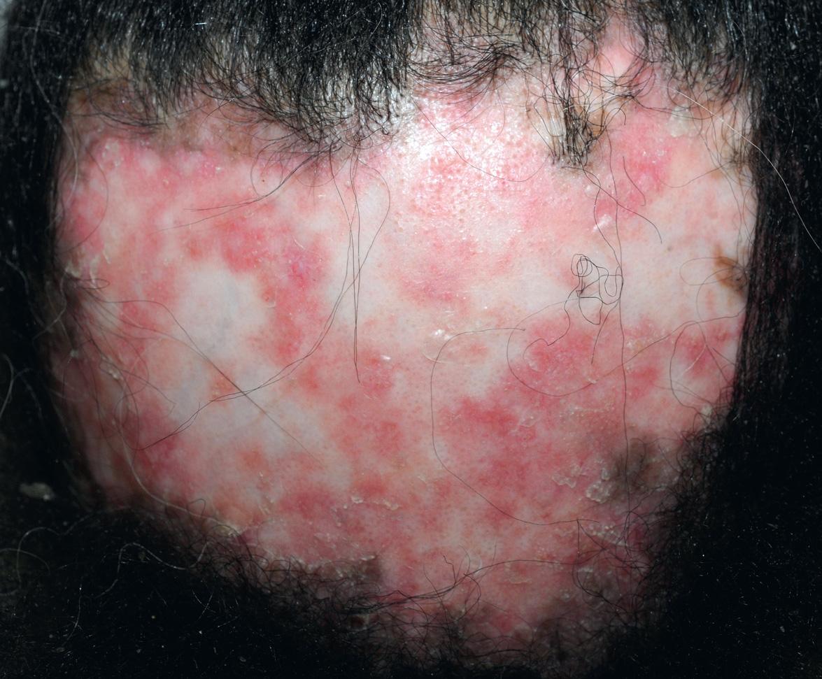 Fig. 41.6, Discoid lupus erythematosus (DLE) lesions with dyspigmentation and scarring alopecia.