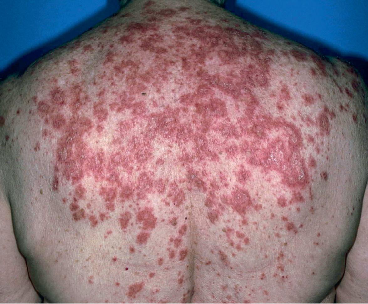 Fig. 41.7, Subacute cutaneous lupus erythematosus (SCLE).