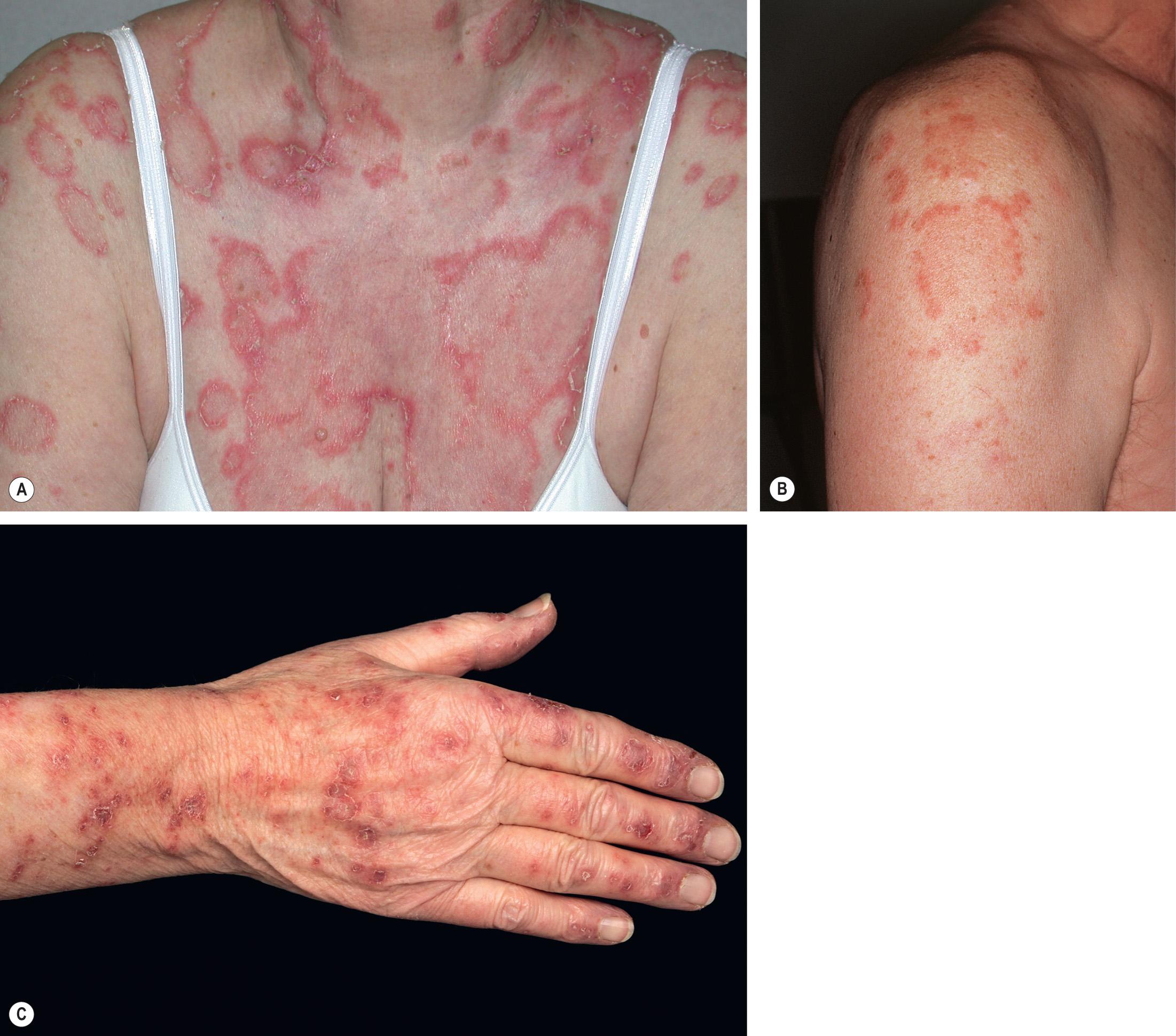 Fig. 41.8, Subacute cutaneous lupus erythematosus (SCLE).