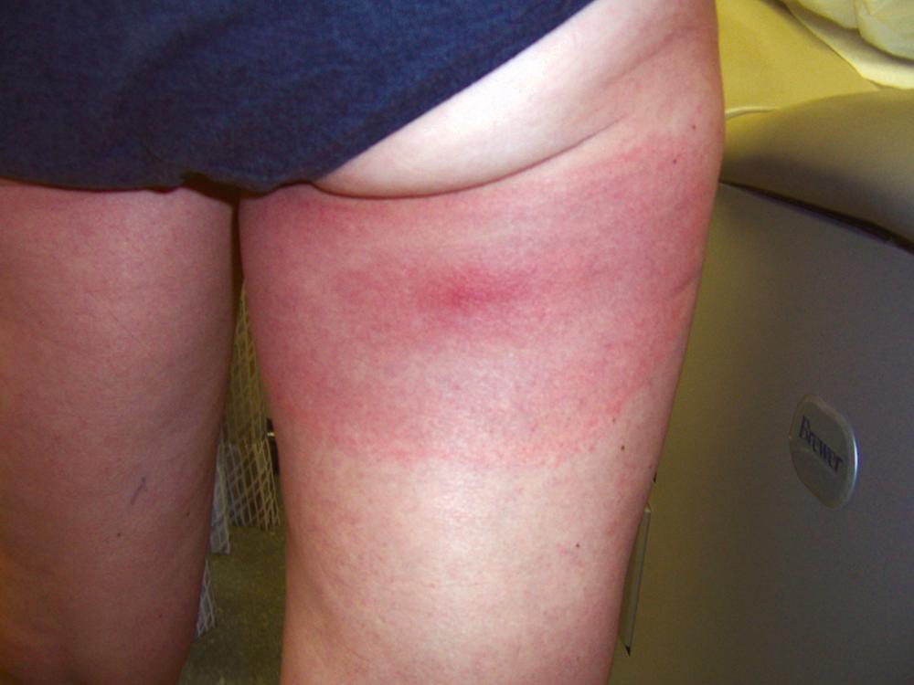 FIGURE 296-2, Erythema migrans skin lesion on the posterior aspect of the right thigh.