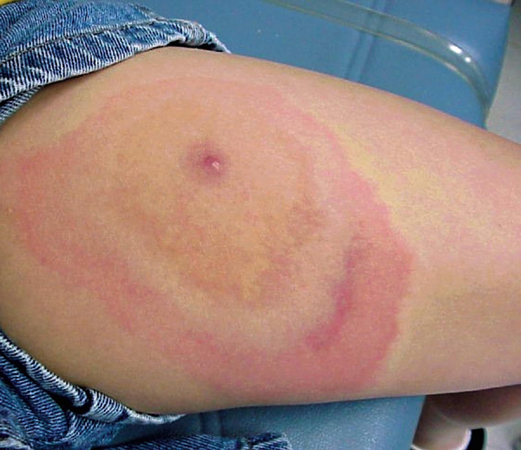 Fig. 36.1, Erythema migrans skin lesion.