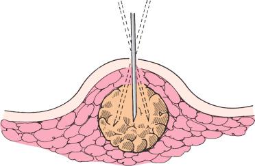 F igure 88-1-3, The needle is moved in and out of the mass in short vibratory strokes for a distance of 2 to 3 mm.