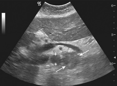 Figure 61-11, Transverse sonographic image of the abdomen in the midline shows a malignant lymph node (arrows) in the left para-aortic region (aorta shown within cursors ). The lymph node is rounded and hypoechoic, with absence of a fatty hilum, features that are indicative of metastatic involvement.