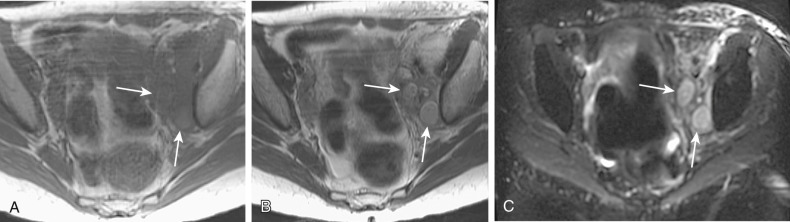 Figure 61-13, A 54-year-old woman with metastatic cervical carcinoma. T1-weighted (A), T2-weighted (B), and diffusion weighted (C) images show two enlarged metastatic left pelvic sidewall lymph nodes (arrows). The metastatic nodes are bright and are more conspicuous on the diffusion-weighted image.