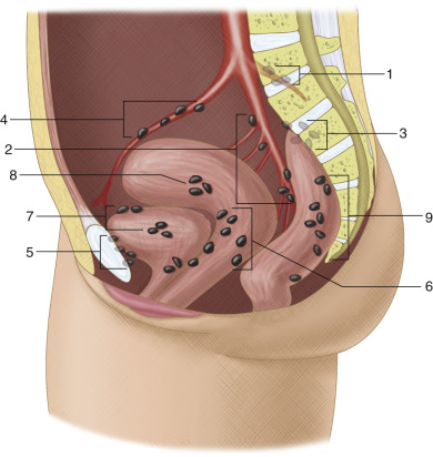 Figure 61-5, Illustration of the lateral view of the pelvis showing the pelvic lymph nodes: 1, superior gluteal; 2, nodes along internal iliac branches; 3, sacral; 4, external iliac; 5, prevesical; 6, paravaginal; 7, lateral vesicular; 8, parauterine; 9, perirectal.