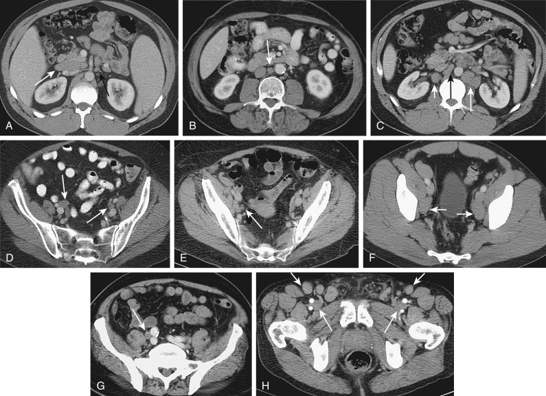 Figure 61-6, Representative axial contrast-enhanced multidetector computed tomography images of the abdomen and pelvis at various levels demonstrating the normal location of the abdominal lymph nodes. A, Portocaval (white arrow) ; SMA (black arrow) . B, Aortocaval (arrow) . C, Paracaval (short white arrow) , aortocaval (black arrow) , paraaortic (long white arrow) . D, Right and left iliac bifurcation (arrows) . E, Right external iliac (arrow) . F, Right and left obturator (arrows) . G, Right common iliac (arrow) . H, Superficial inguinal (short arrows) , deep inguinal (long arrows) . I: 8, Superior mesenteric; 4, pancreaticoduodenal. J: 9, Aortocaval. K: 10, Para-aortic; 11, retrocaval; 12, paracaval. L: 13, External iliac. M: 14, Internal iliac. N: 15, Obturator. O: 16, Common iliac. P: 17, Superficial inguinal; 18, deep inguinal.