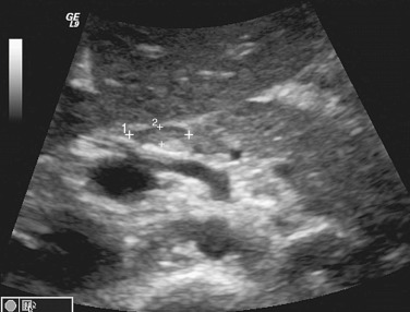 Figure 61-10, Transverse sonographic image of the abdomen in the midline shows a benign lymph node in the peripancreatic region (cursors). The lymph node is oval and elongated with an echogenic eccentric area representing the fatty hilum.