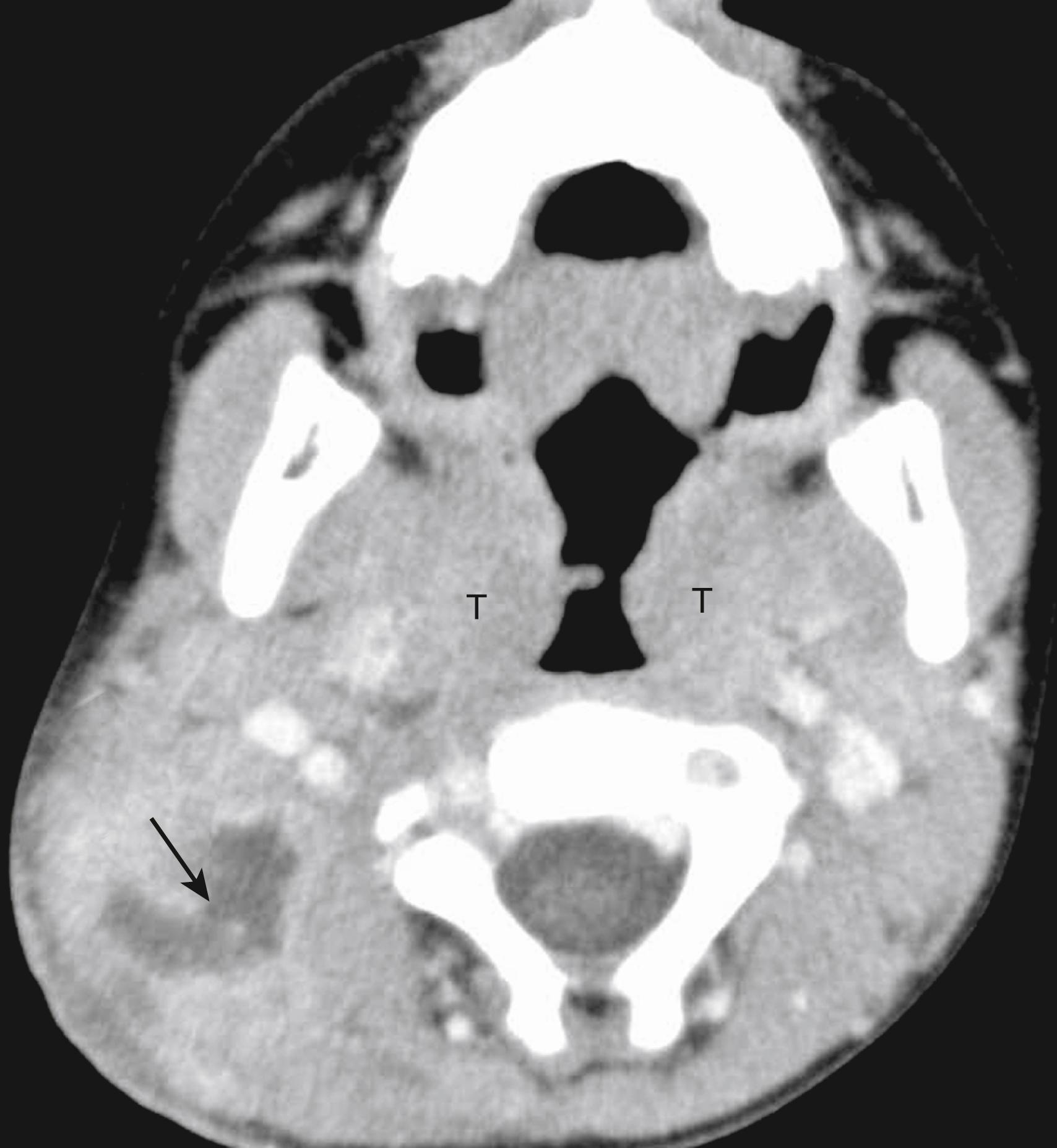 Fig. 48.5, Suppurative lymphadenitis in a 5-year-old female with neck swelling and redness. Contrast-enhanced CT image reveals a group of enlarged nodes in the right posterior triangle with central hypoattenuating necrosis (arrow). Also, note the enlarged tonsils (T) in this child with recurrent tonsillitis.