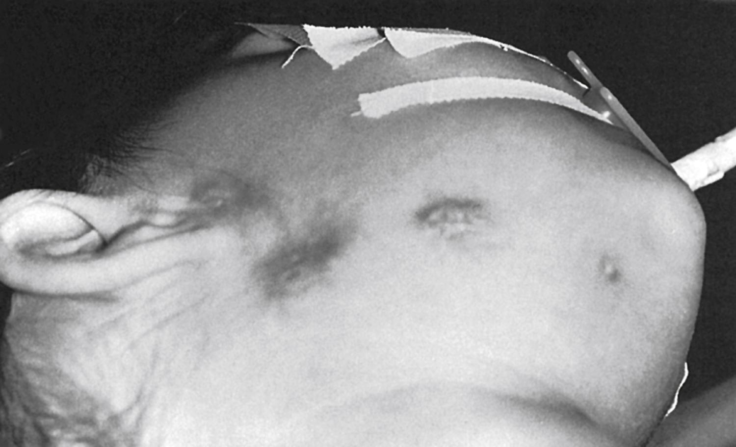 Fig. 48.6, Atypical mycobacterial infection frequently involves the submandibular triangle and preauricular regions.