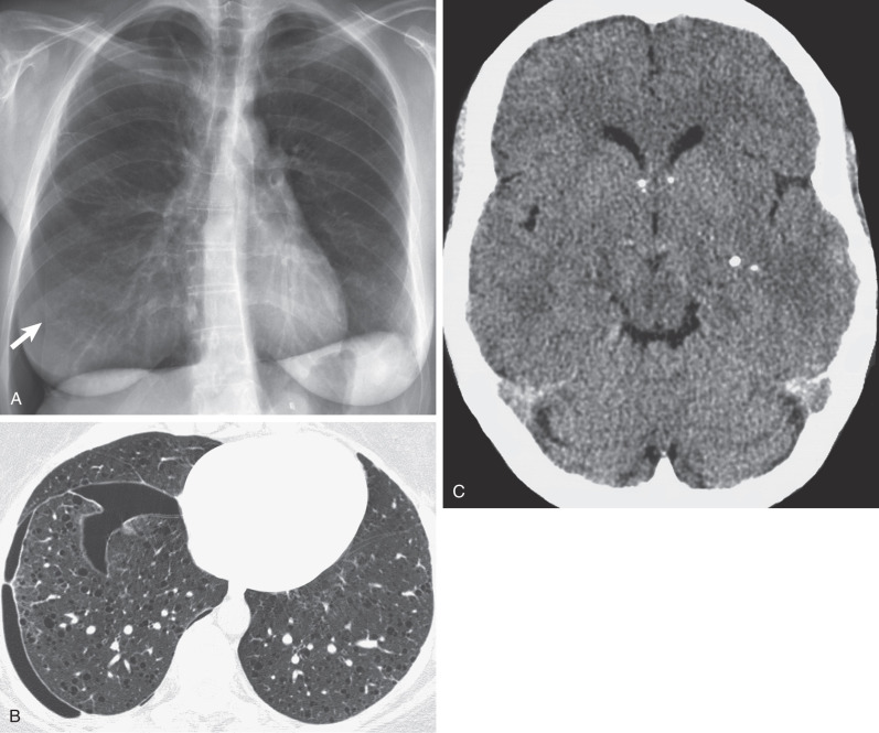 Fig. 35.1, Tuberous sclerosis complex–associated lymphangioleiomyomatosis in a 34-year-old woman. (A) Posteroanterior chest radiograph shows a moderate-sized right pneumothorax (arrow). There is a fine reticular pattern most prominent in the lower zones. Tethering of the lateral aspect of the left hemidiaphragm was thought to be a consequence of a previous pneumothorax. (B) High-resolution CT scan shows the small right pneumothorax and several thin-walled cysts uniformly distributed throughout the lungs. (C) Noncontrast CT of the head shows calcified nodules consistent with multifocal tubers.