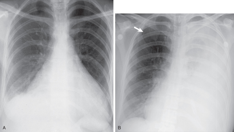 Fig. 35.2, Chylous pleural and pericardial effusions in lymphangioleiomyomatosis. (A) Posteroanterior chest radiograph shows an enlarged cardiac silhouette shown to represent a chylous pericardial effusion. Note a moderate right pleural effusion. Several small cysts were identified on an accompanying high-resolution CT scan (not shown). (B) Posteroanterior chest radiograph from a different patient shows a large left pleural effusion and a contralateral right apical pneumothorax (arrow). The left pleural effusion was chylous on diagnostic and therapeutic thoracentesis.