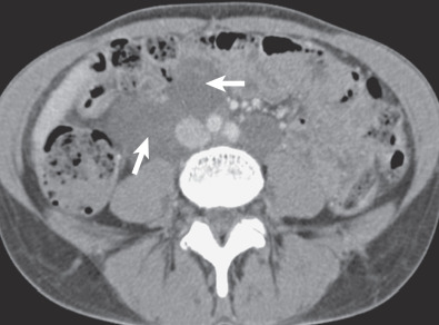 Fig. 35.3, Lymphangioleiomyomas in a 55-year-old woman with sporadic lymphangioleiomyomatosis. Contrast-enhanced CT of the lower abdomen shows a large low-attenuation lobulated mass (arrows), consistent with a lymphangioleiomyoma.