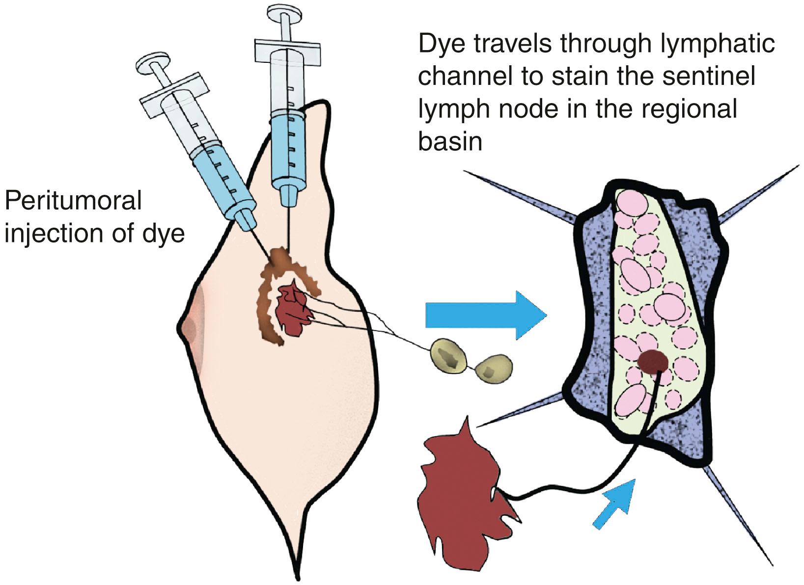 Fig. 33.1, Schematic diagram of blue dye transit from primary breast tumor to sentinel node.