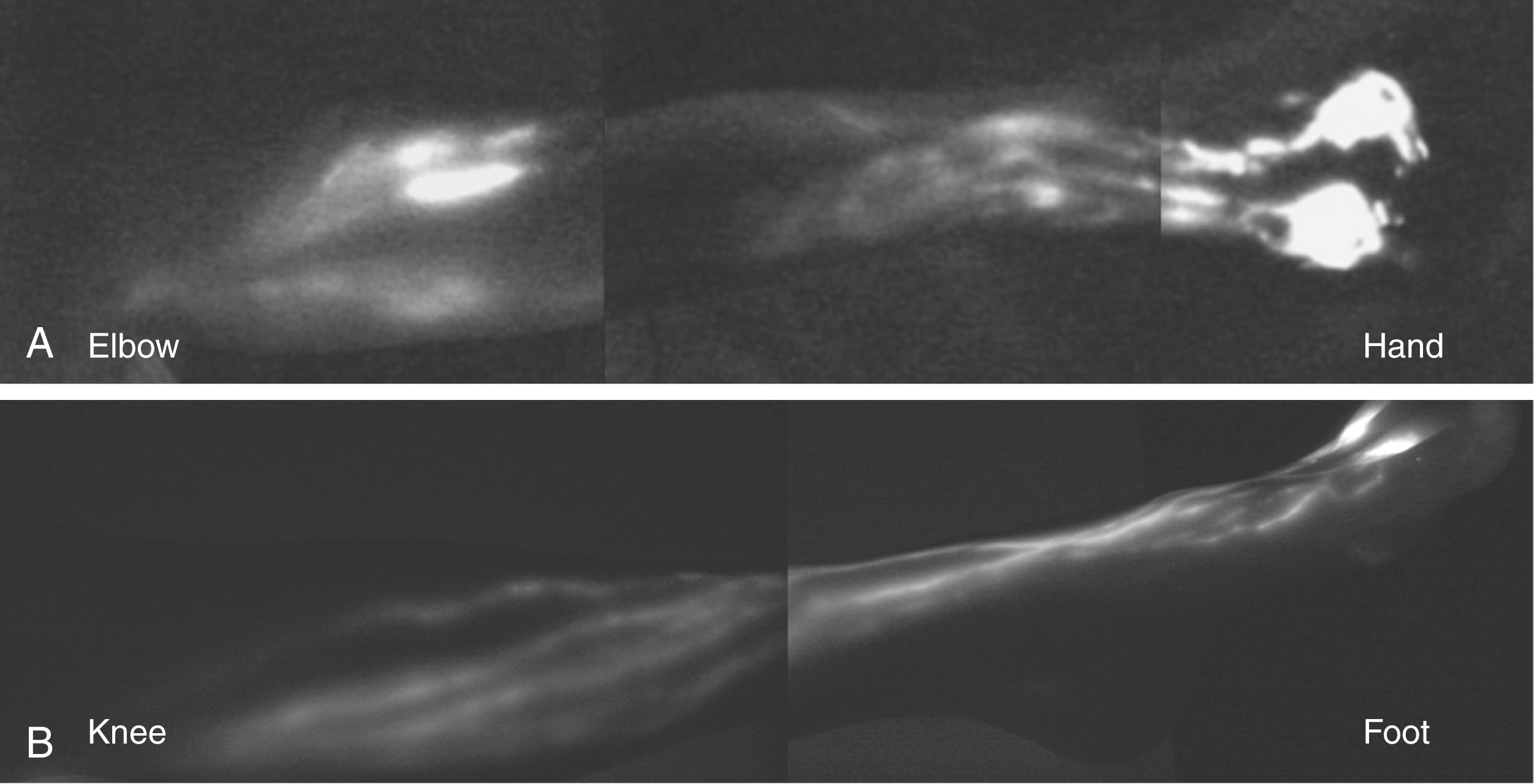 Fig. 44.2, (A) ICG anatomy of a healthy upper limb (volar view). Note dual drainage from the hand along radial and ulnar bundles of lymphatic channels and convergence of these pathways at the elbow. (B) ICG anatomy of a healthy lower limb (anteromedial view). Note drainage along the medial border of the leg.