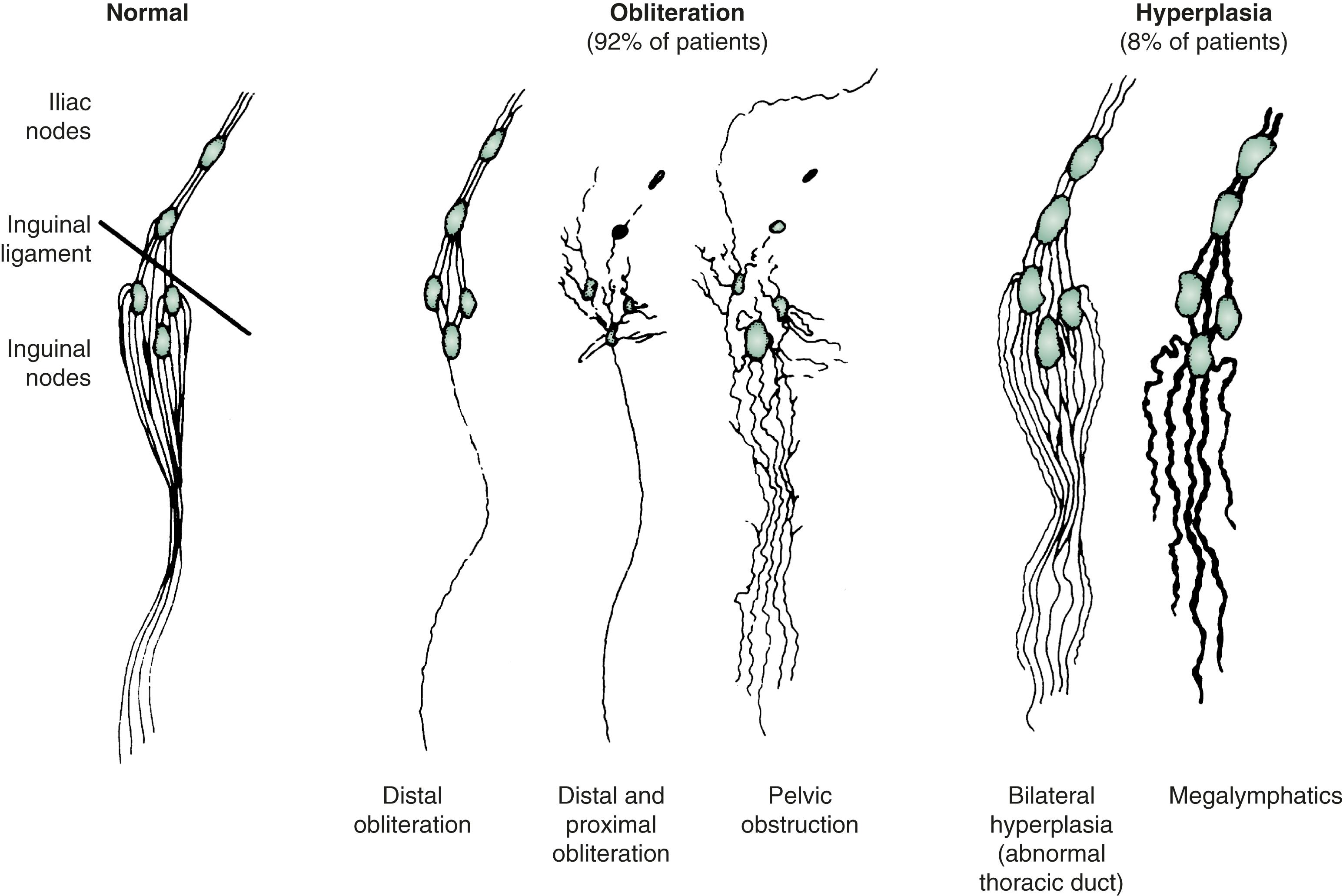 Figure 167.1, Lymphangiographic patterns of lymphatic morphology in a normal lower limb and in patients with different types of primary lymphedema. Obliteration of the lymphatic pathways may be due to aplasia, hypoplasia, or obstruction of the lymphatic channels and nodes.