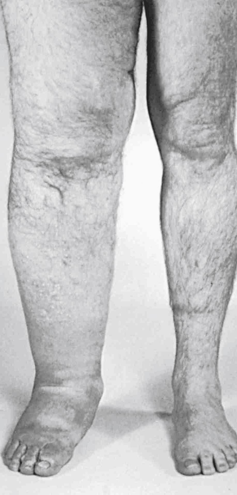 Figure 167.2, Primary lymphedema of the right leg caused by hyperplasia of the lymphatics and valvular incompetence. Mid-calf skin vesicles contain a milky fluid because of lymphangiectasia and reflux of chyle.