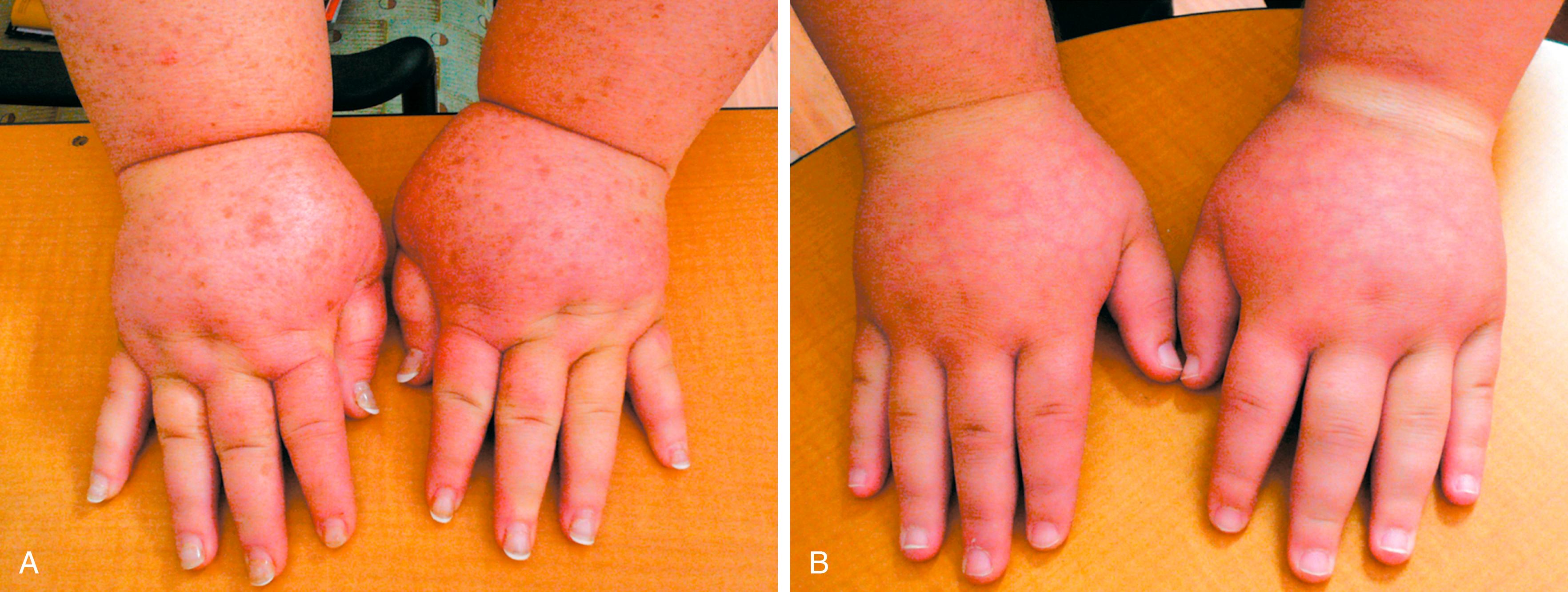 Figure 167.3, ( A ) Adult patient with congenital lymphedema. In addition to the bilateral arm lymphedema depicted, she has edema of both legs and the face. ( B ) Upper extremities of this patient’s 18-year-old son, who has a similar distribution of lymphedema. This is an example of Milroy disease.