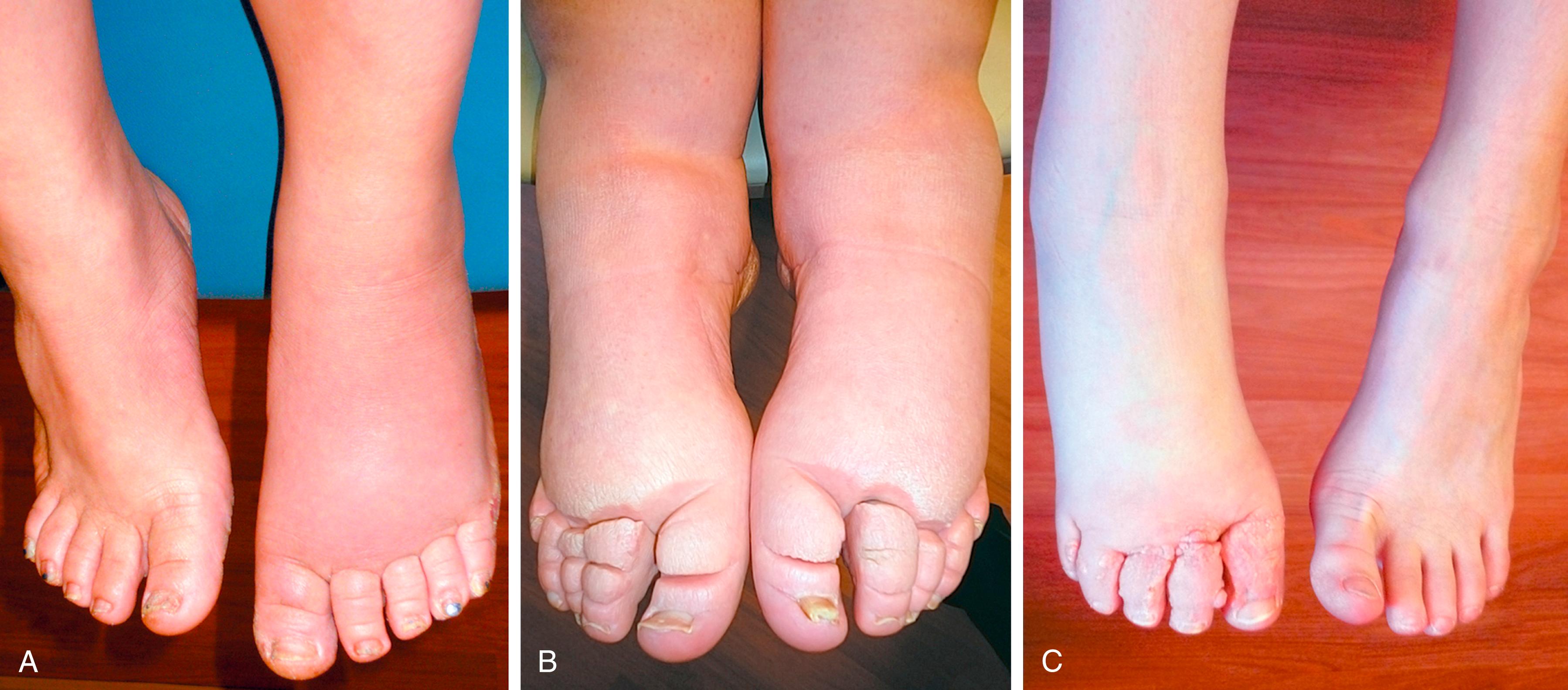 Figure 167.4, Chronic Acquired Lymphedema of the Lower Extremities.