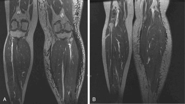 Figure 8.4, (A) MRA of the leg, coronal section. Lymphedema of the left leg in a patient with a significant fluid component (black = fluid). (B) Lymphedema of the left leg in a different patient with pronounced fat hypertrophy and a relatively smaller fluid component. These patients may respond differently to LVA or VLNT in terms of volume reduction.