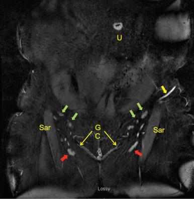 Figure 8.5, MRA of the pelvis, coronal section illustrating location of the target lymph nodes (green arrows) and the sentinel lymph nodes draining the lower limbs (red arrows). U, umbilicus; GC, groin crease; Sar, sartorius; Yellow arrow, distal superficial circumflex iliac vein.