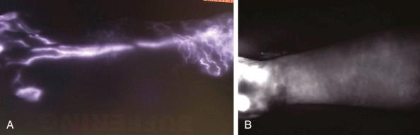 Figure 8.6, (A) Indocyanine green lymphangiography (IGL) in a lymphedema patient with some dermal backflow but a single functional lymphatic vessel. Potential candidate for LVA. (B) IGL of a patient with advanced lymphedema and diffuse dermal backflow.