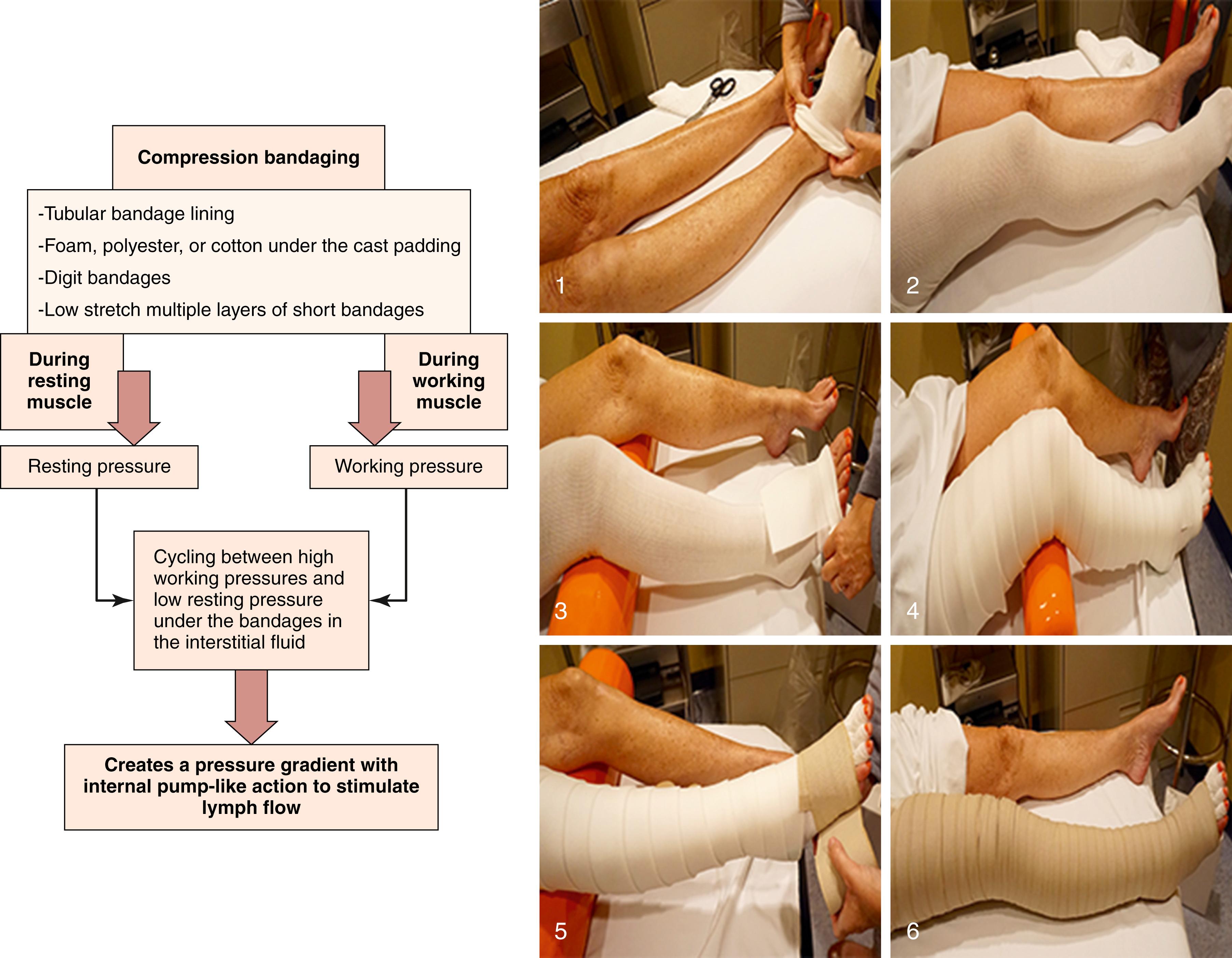 Figure 168.8, Compression Bandaging.