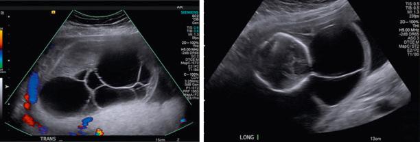 Fig. 121.1, Cystic hygroma in a 22-week fetus with multiple septations and oligohydramnios.