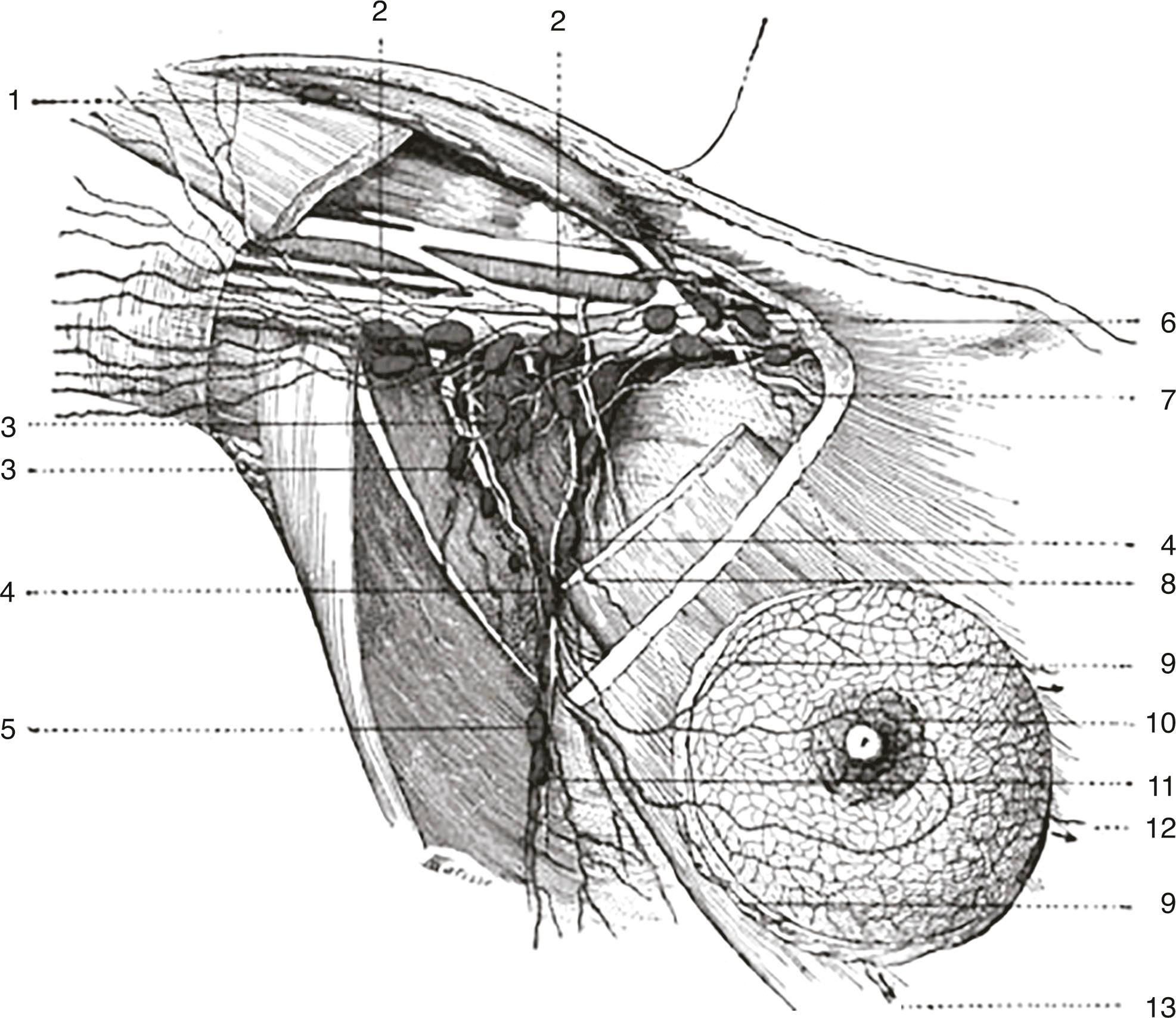 Fig. 76.1, Poirer and Cuneo’s summary of breast drainage. This diagram was based on the anatomic and clinical findings of several people, including Sappey.