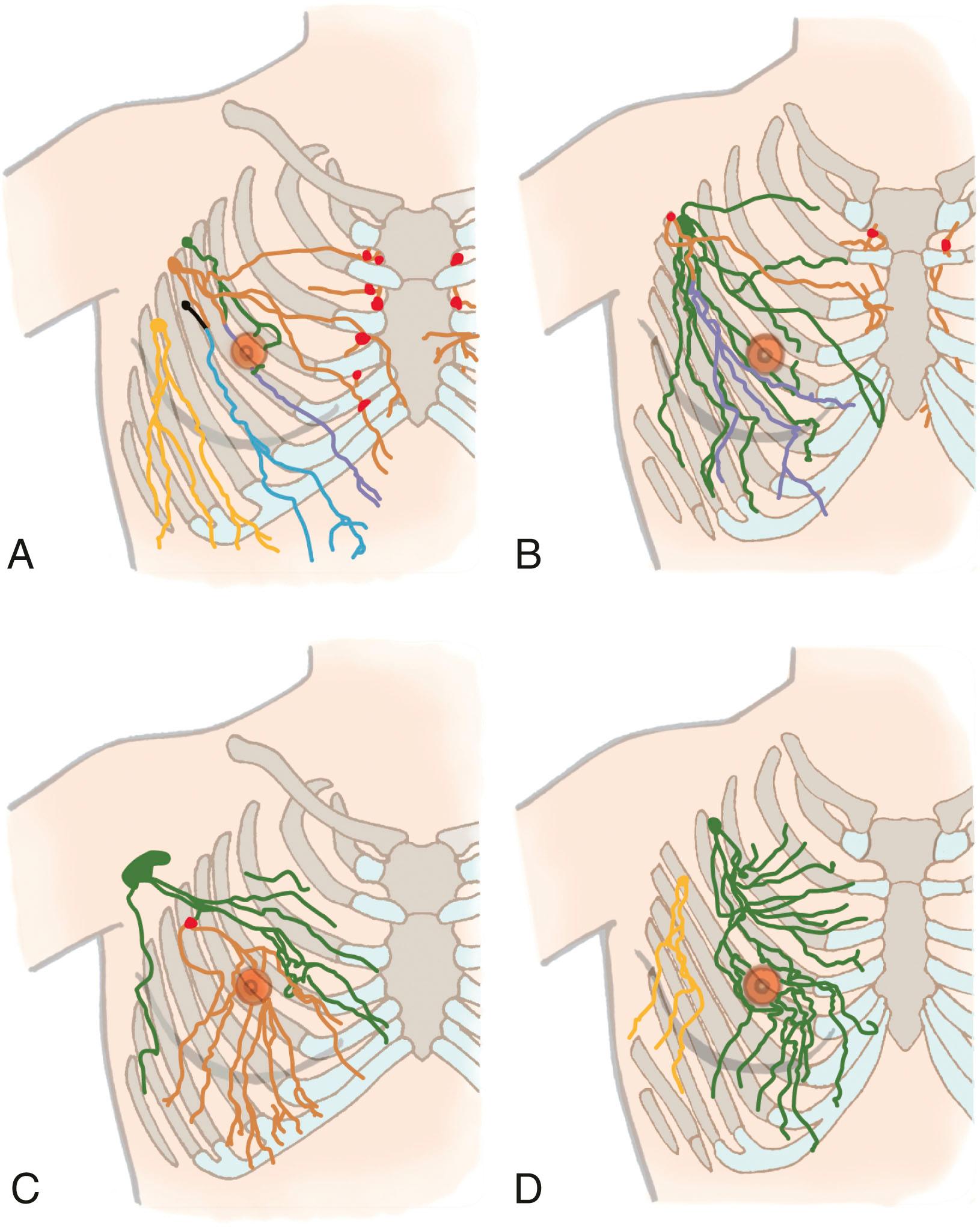 Fig. 76.3, (A and C) Male lymphatics. (B and D) Female lymphatics. Tracing distally of lymphatics of both partial upper torsos from each first-tier lymph node color-coded: pectoral nodes ( green, orange, black , and yellow ), subclavicular node (light blue) , and internal mammary node (red) . Lymphatics from nipple and areolar region drain into green-colored lymph nodes. Breast lies in the pathway of collecting lymphatics that start peripherally. Although the majority of the breast drains into one sentinel node, as in (D), every breast area is drained by more than one first-tier node.