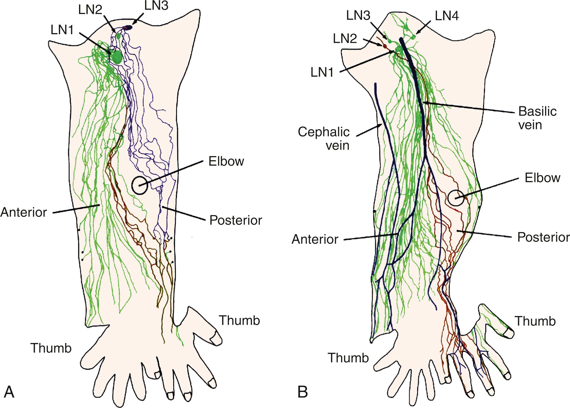 Fig. 76.7, (A) Tracing of lymphatics distally from each lymph node and color-coded to define territories. Note that territories of each node do not overlap; orange territory can drain either into LN1 or LN3. Interconnections within each territory are noted. (B) Veins have been injected. Also noted is the dominant territory of LN1 that connects proximally to two other nodes, LN3 and LN4.