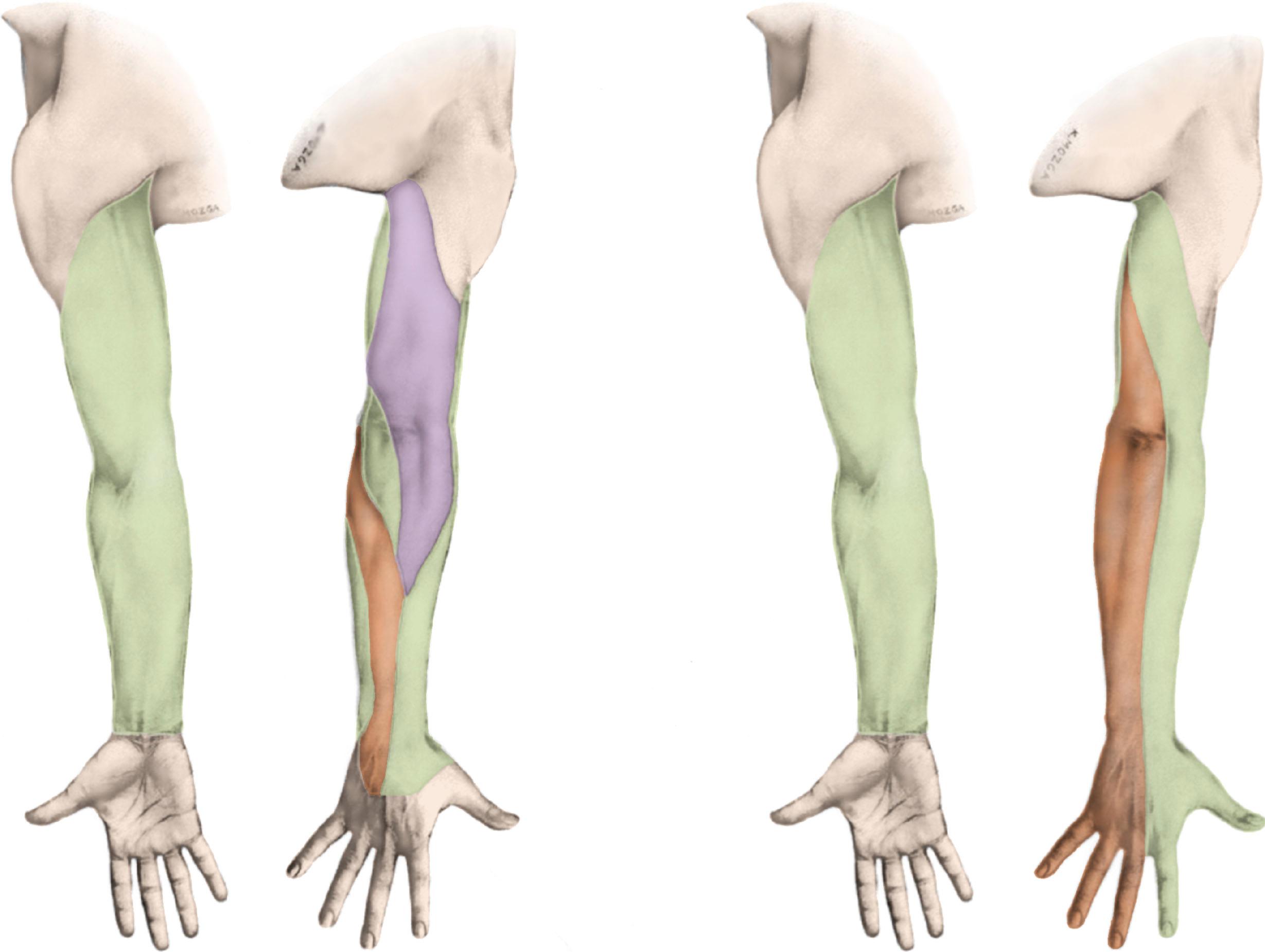 Fig. 76.8, Lymphatic territories of each sentinel node colored to match those of Fig. 76.7.