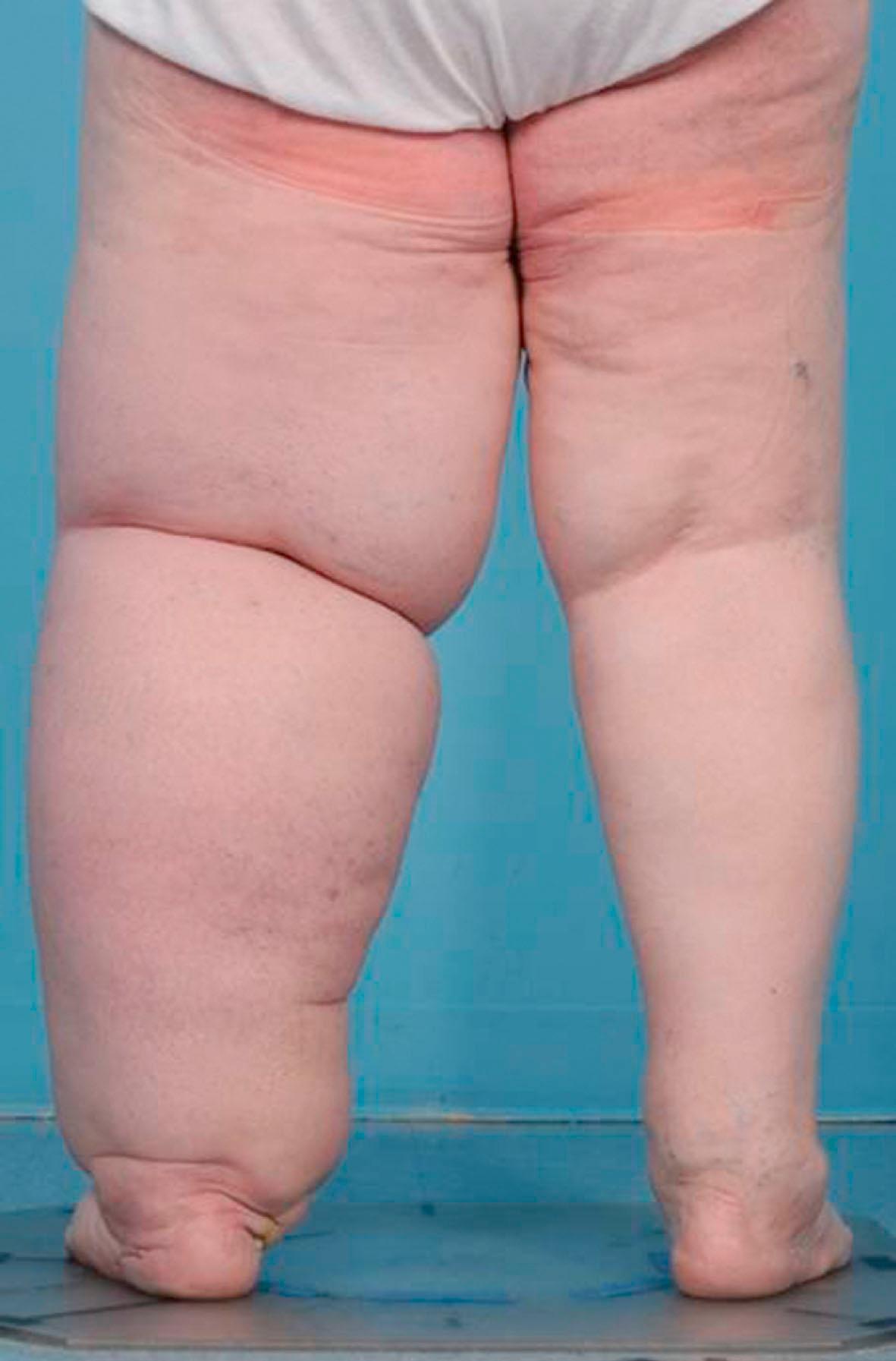 Figure 28.1, Severe (grade III) lymphedema of the left leg after melanoma resection.