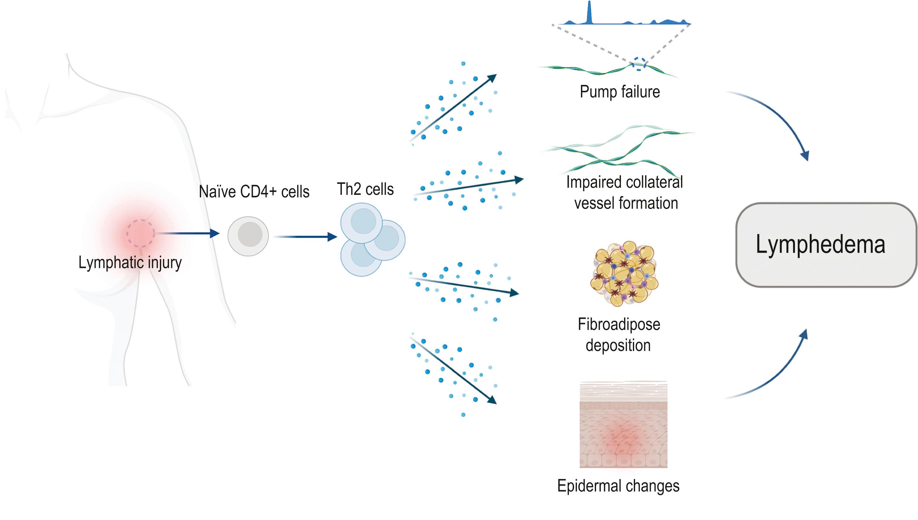 Figure 28.7, The role of Th2 cells in the pathophysiology of lymphedema. Th2 cells critically influence the pathological mechanisms that translate lymphatic injury to the development of lymphedema, regulating multiple overlapping mechanisms, including: lymphatic pump failure, impaired collateral vessel formation, adipose deposition, and epidermal changes.