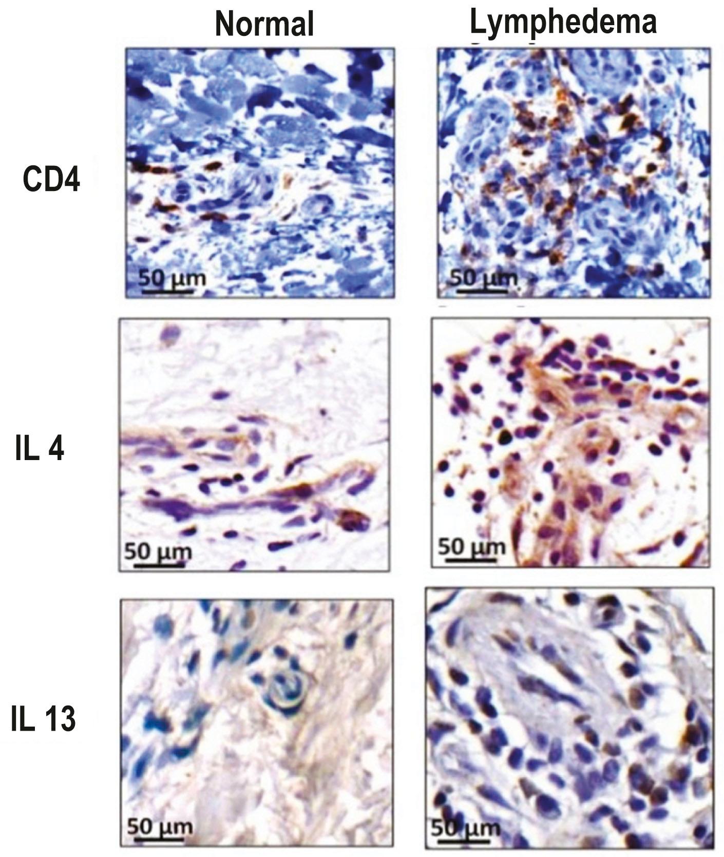 Figure 28.8, Role of CD4 + cells in lymphedema. Representative immuno-histochemistry images demonstrating CD4 + (upper), IL-4 + (middle), and IL-13 + (lower) cells in matched human biopsy specimens comparing lymphedematous and contralateral normal upper extremities.