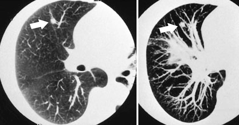 FIG. 22.1, CT scan of intraparenchymal lymph node (arrow). Radiographically, this nodule has a rough border and was accordingly resected to exclude carcinoma.