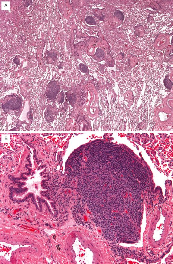 FIG. 22.4, Follicular bronchiolitis. (A) Diffuse lymphoid hyperplasia. Low-power view shows numerous reactive germinal centers adjacent to bronchioles and along interlobular septa. Given the additional involvement along interlobular septa and pleura, some pathologists would use the term diffuse lymphoid hyperplasia. (B) Intermediate-power view shows a reactive germinal center present between a terminal bronchiole and pulmonary arteriole.