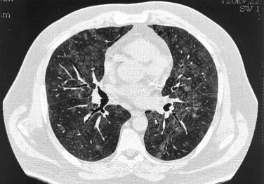 FIG. 22.5, Thin-section CT scan of LIP in a 41-year-old male with HIV. There are patchy ground-glass opacities and ill-defined centrilobular nodules affecting all lobes.