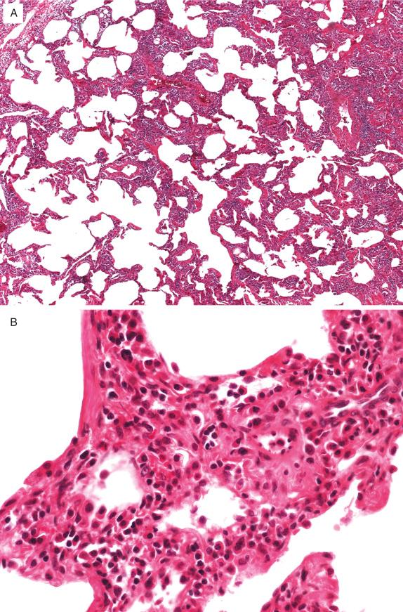 FIG. 22.6, Lymphoid interstitial pneumonia. (A) Low-power view shows diffuse expansion of alveolar septa by a cellular inflammatory infiltrate. (B) High-power view shows that the interstitial infiltrate is composed of lymphocytes, histiocytes, and plasma cells.